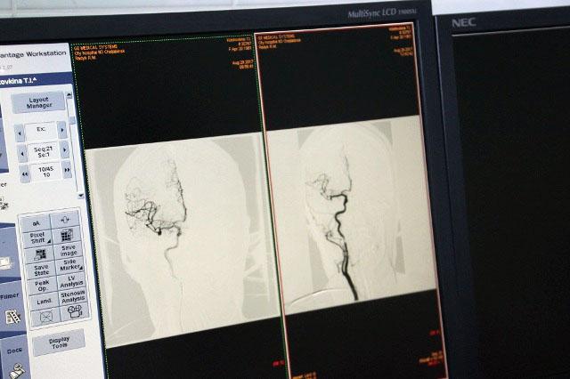 Фото Челябинские нейрохирурги внедрили новую технологию по лечению аневризмы в головном мозге
