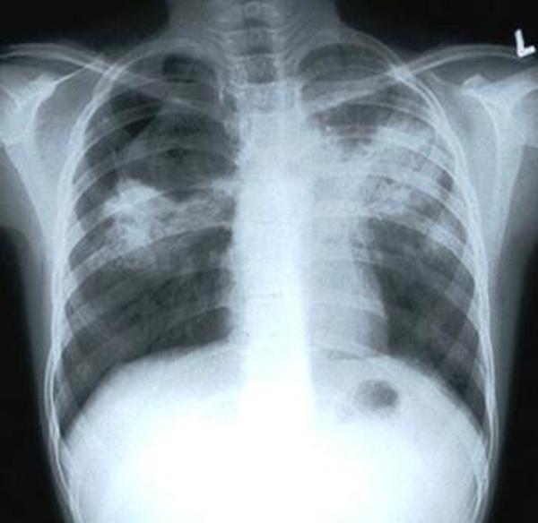 Фото Жительницу Кусинского района заставили лечиться от туберкулеза