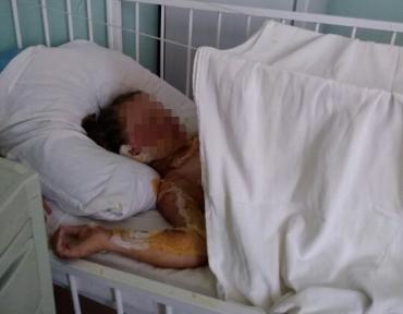 Фото  На озере Чебаркуль шестилетнюю девочку подожгли  средством для розжига