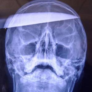 Фото Попытка убийства, как в кино: преступник сломал в голове жертвы клинок ножа
