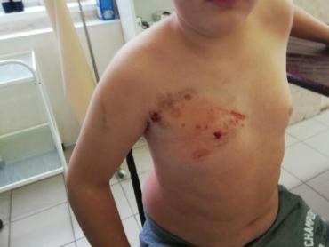 Фото В Магнитогорске огромный алабай искусал подростка
